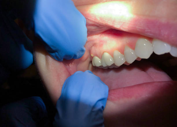 Best Emergency Care for Gum Disease in Kachina Village, AZ